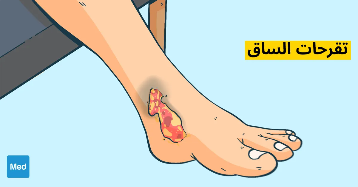 تقرحات الساق